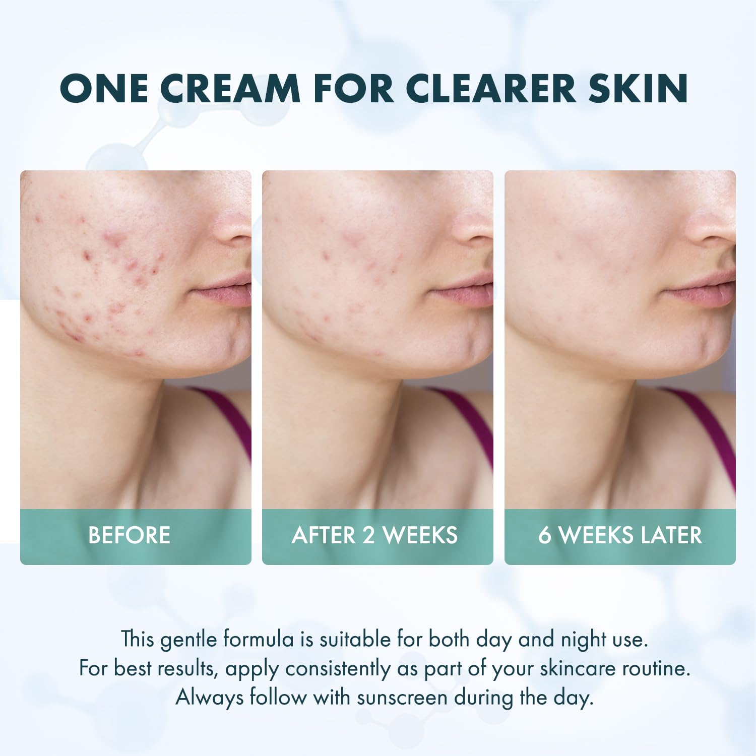 Rossy 12% Azelaic Acid Acne Cream 50ml Daily Anti-Blemish Facial Treatment for All Skin Types - Image 6