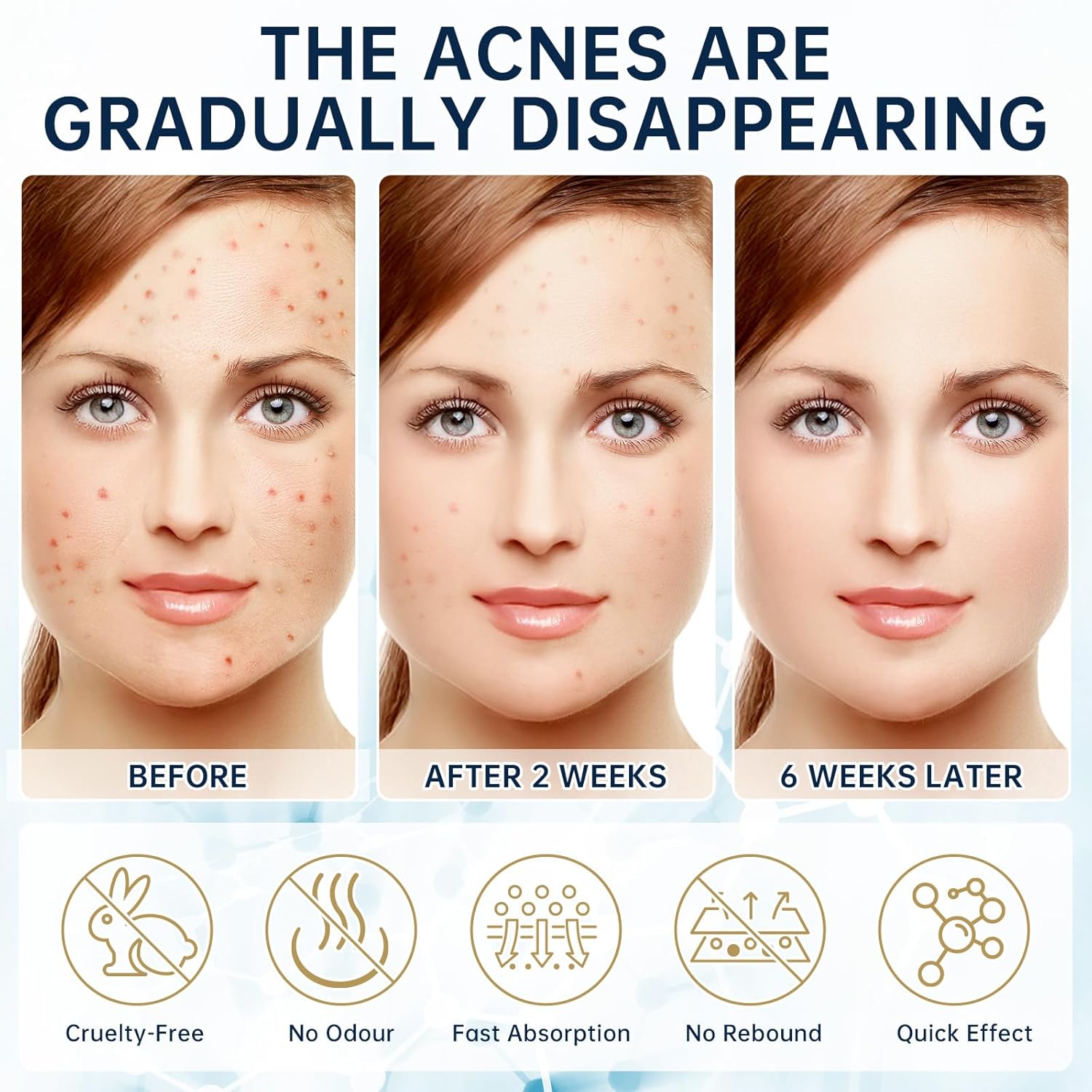 14% Azelaic Acid Acne Face Cream and Serum Set Hyaluronic Acid Niacinamide Squalane 2PCS All Skin Types - Image 5