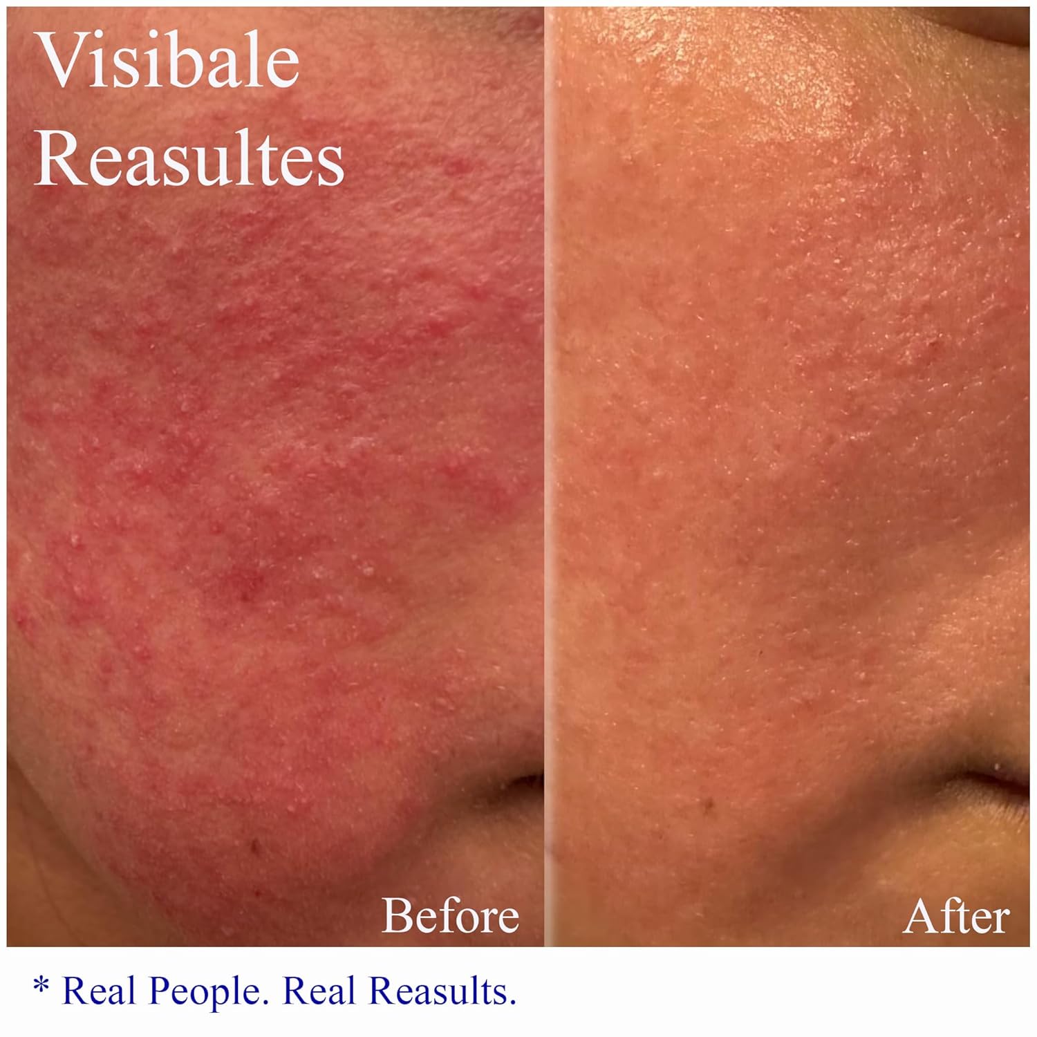 Hey Honey Skincare Relax Instant Rosacea Treatment 2.2 Oz Calming Moisturizer for Sensitive Skin - Image 2