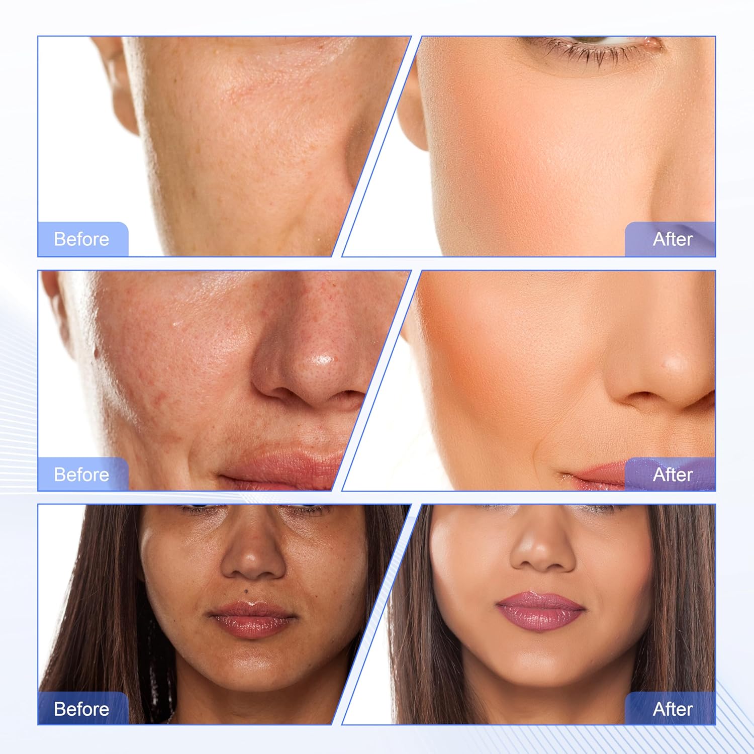 Hydradermabrasion Facial Machine Skin Peel Water Treatment ETWD007 Model 1 Liter Capacity - Image 8