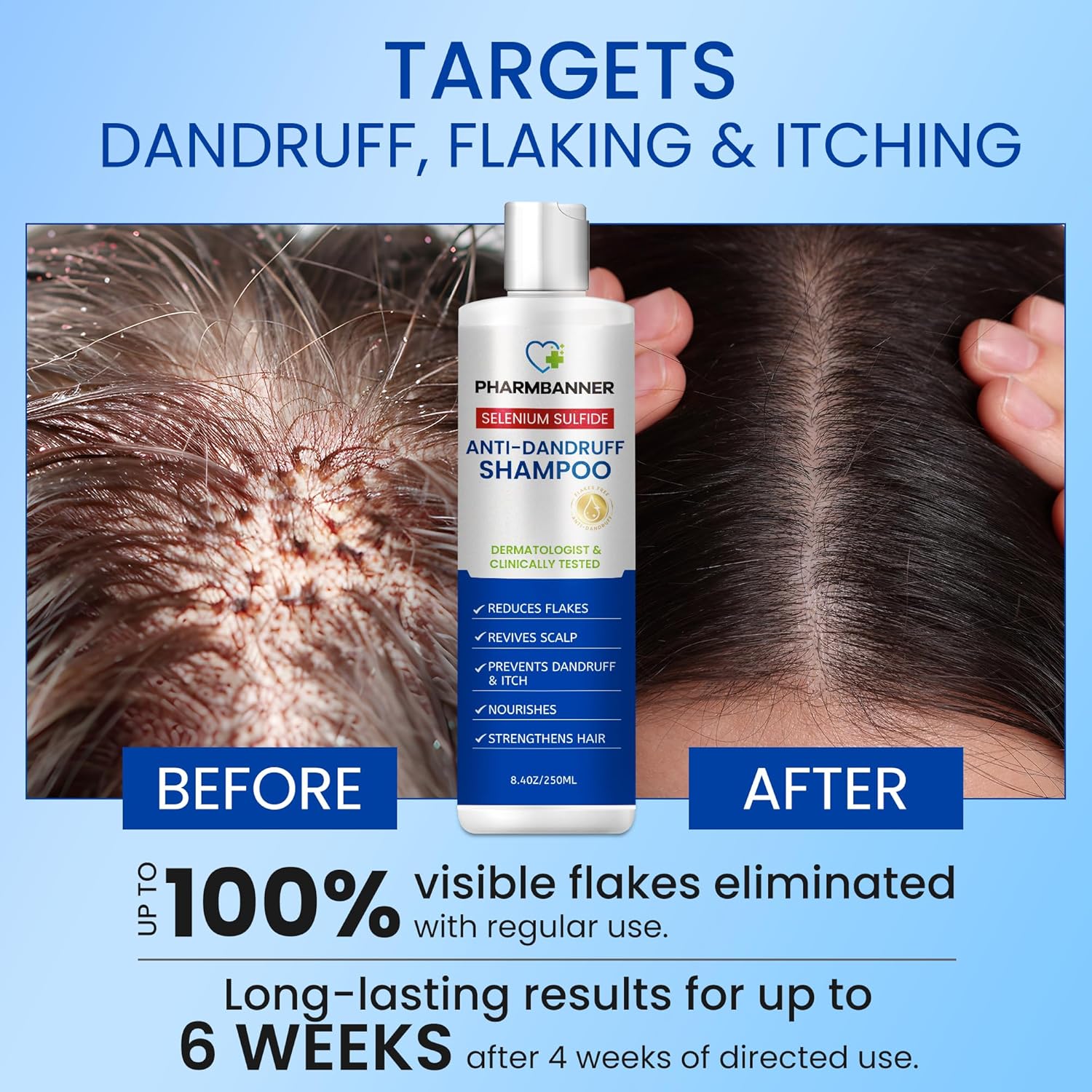 Selenium Sulfide Anti-Dandruff Shampoo for Flaky Scalp and Itching Relief, 8.4oz Bottle - Image 2