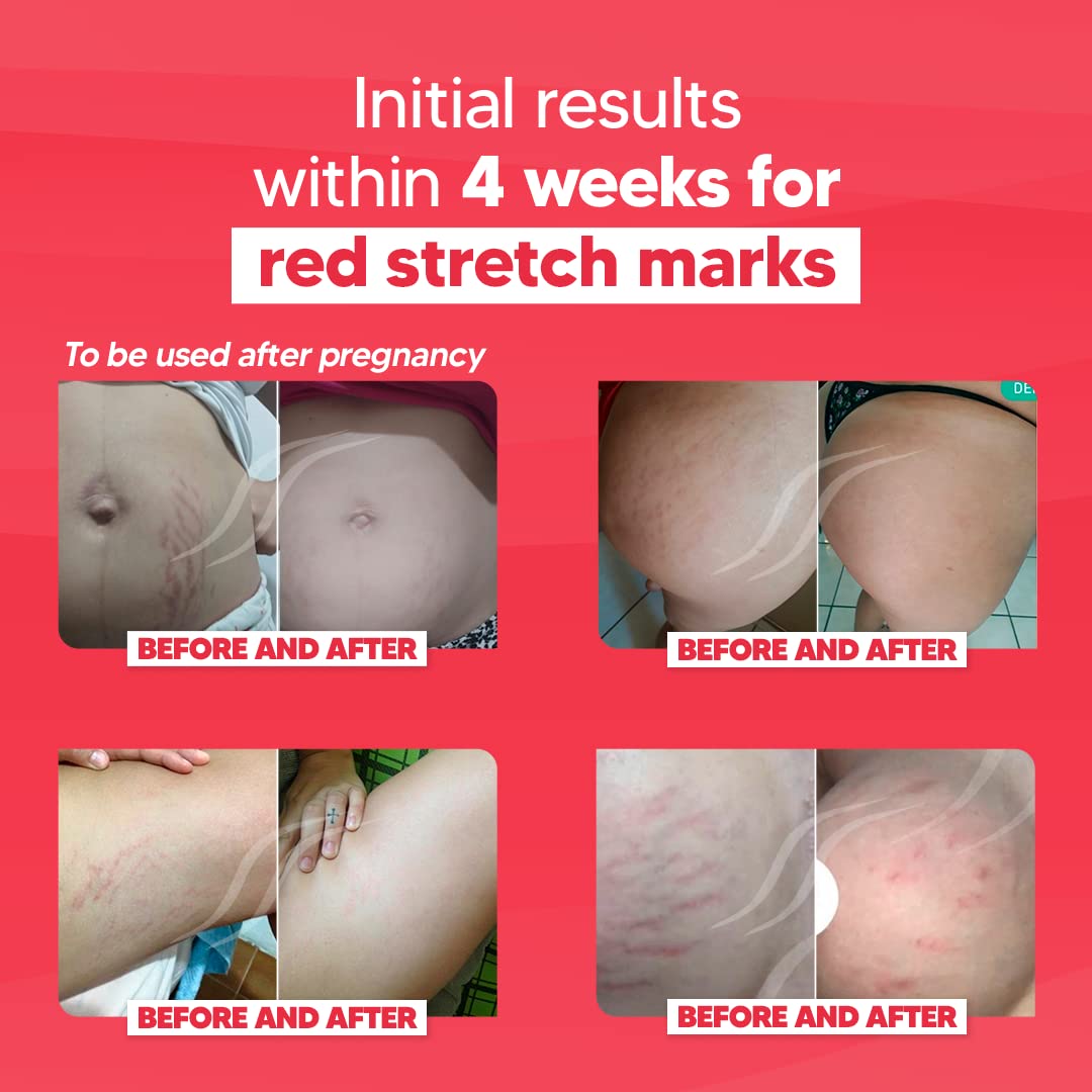 Cicatrissim Red Stretch Mark Removal Cream 100ml for All Skin Types - Image 4