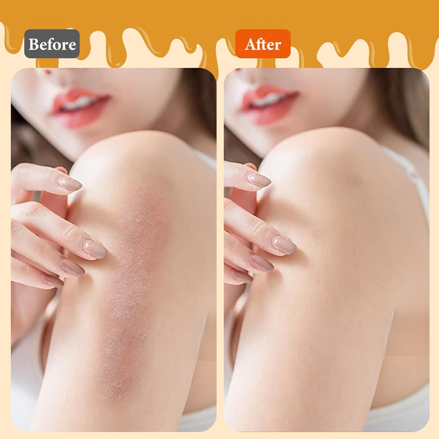 Manuka Honey Bee Venom Eczema Cream Natural Dry Skin Relief Moisturizer 4 oz - Image 7