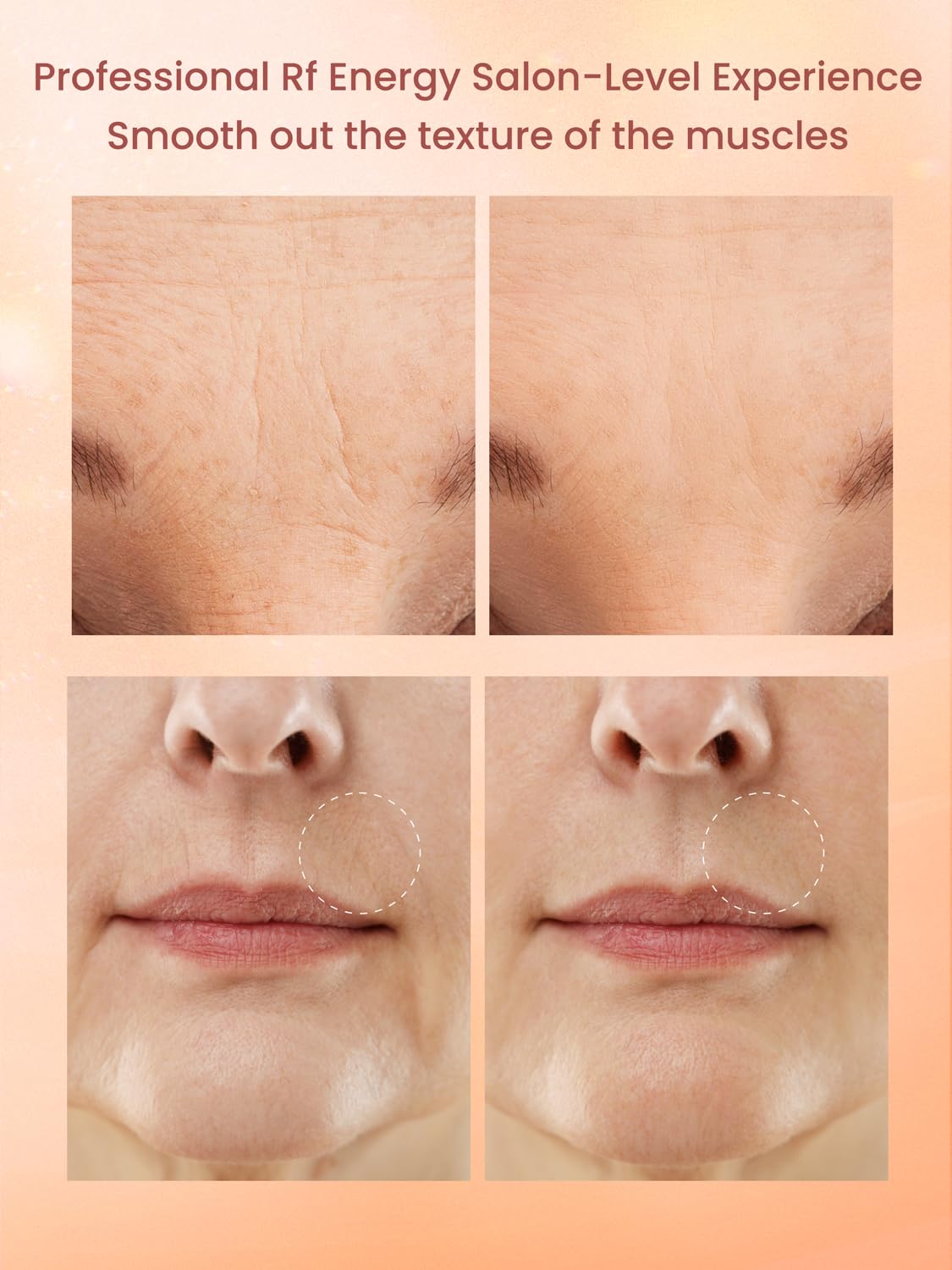 Professional Wireless RF Skin Tightening Device for Anti-Aging, Lifting and Firming, 3 Levels - Image 7