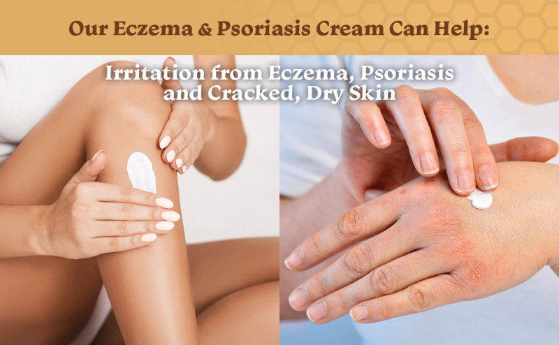 Benefits of Eczema Cream