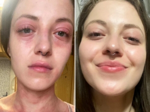 Grahams Natural Face and Eyelid Eczema Cream Before and after czako