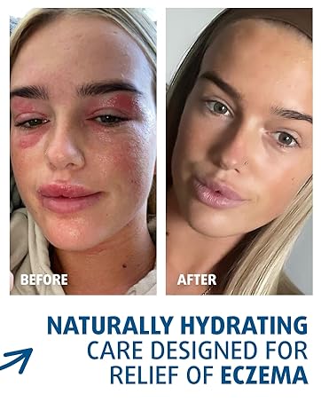 natural hydrating moisturizer for eczema prone skin