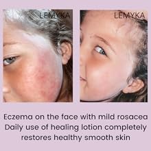 eczema face cream facial rash anti rosacea treatment lotion itchy skin itch relief natural healing