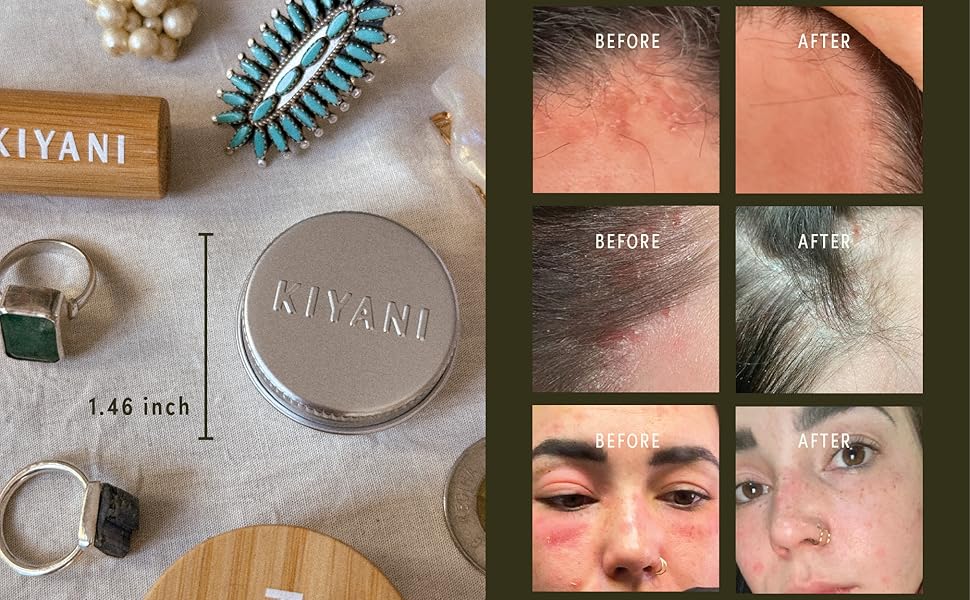 before and after of psoriasis