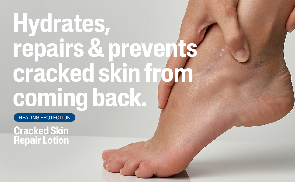 Cracked Skin Lotion