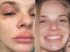 Grahams Natural Face and Eyelid Eczema Cream before and after Jessie