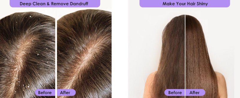 Scalp Exfoliator for Dandruff Removal