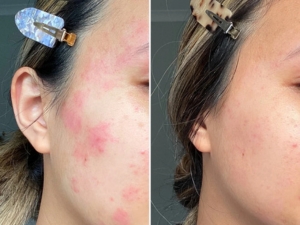 Grahams Natural Face and Eyelid Cream For Eczema before and after Jamie