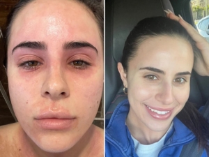 Grahams Natural Face and Eyelid Cream for Eczema before and after Sabrina