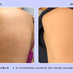 zitsticka body double acne wash