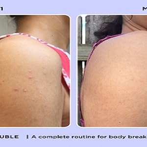 zitsticka body double acne wash