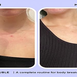 zitsticka body double acne wash