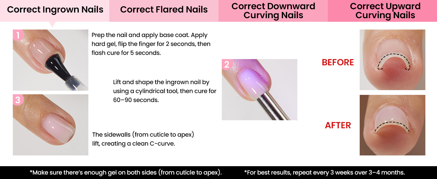 Correct Ingrown Nails
