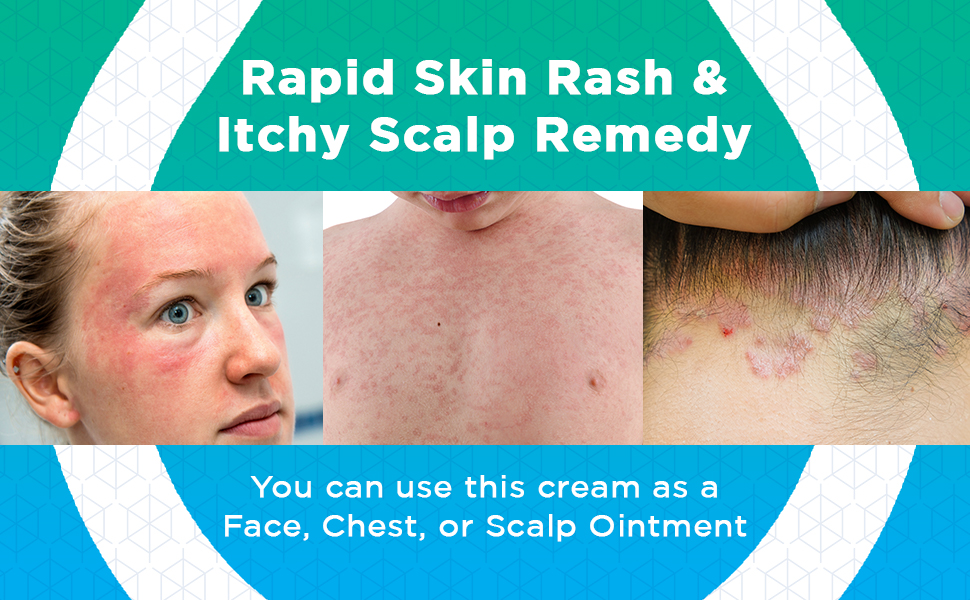 skin rash cream seborrheic dermatitis itchy scalp relief remedy ointment eczema skin relief