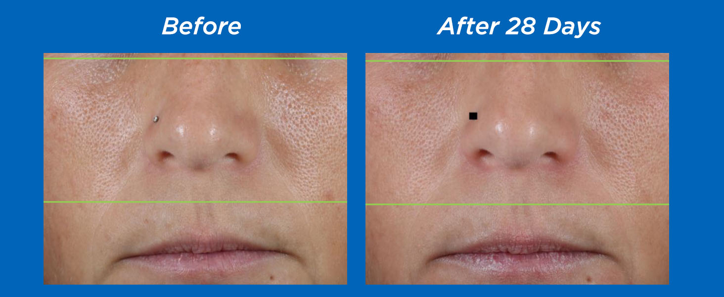 Before and After 28 Days