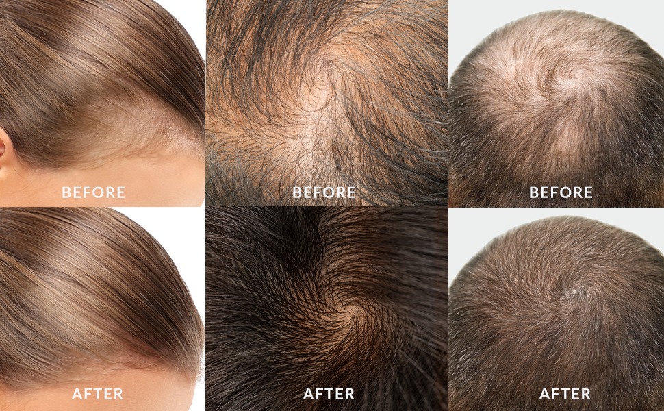 Black rice hair growth, rice water hair growth, hair growth trreatment, anti-hair loss