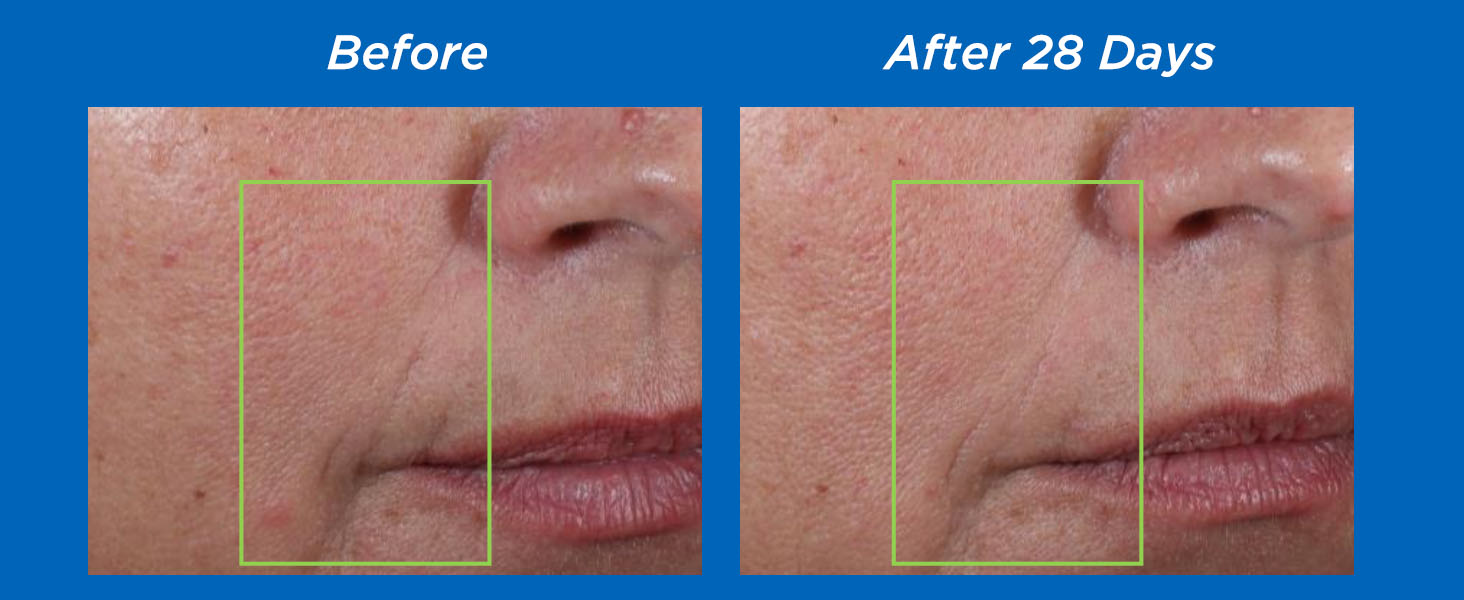 Before and After 28 Days