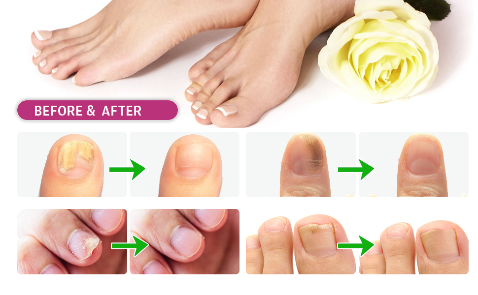 Toenail Fungus Treatment