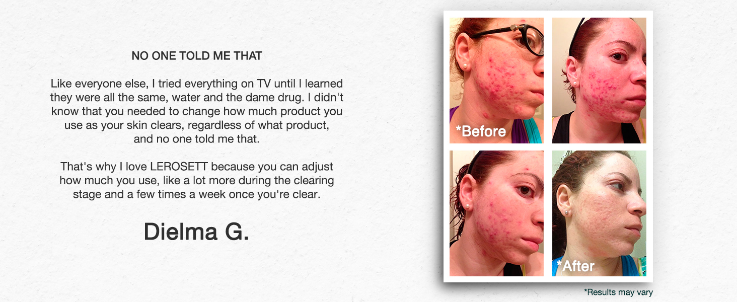 Dielma before and after using spot treatment