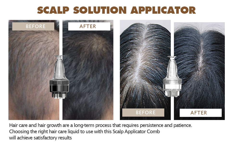 treat male type baldness and female type hair loss