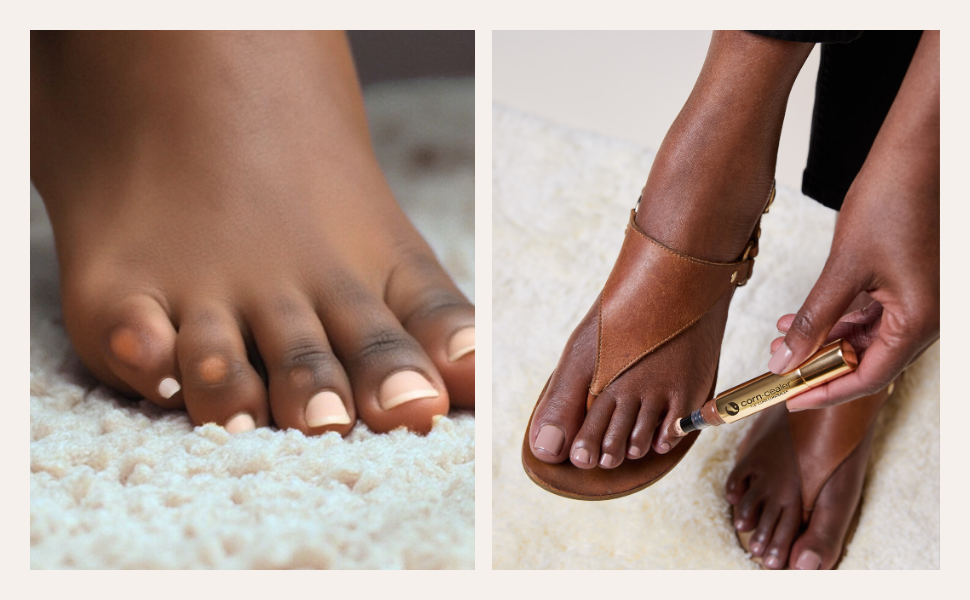 Toe corns shown on a black woman's foot, and second image shows her applying Corn-Cealer